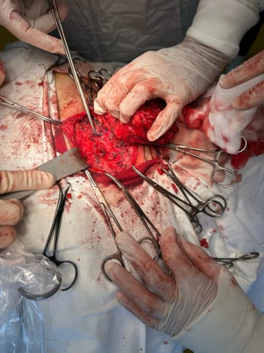 Tumor